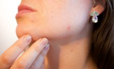 Hudpleie mot kviser: En grundig oversikt over effektiv behandling for kviser